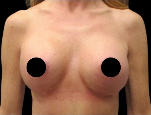 After: Breast Aug/Lift · by Angelo Cuzalina, MD, DDS