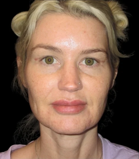 After: Upper Blepharoplasty — front · by Carisa Champion, DO