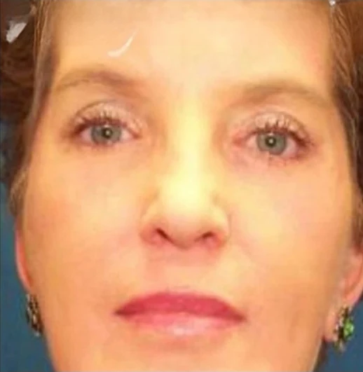 After: Blepharoplasty · by Angelo Cuzalina, MD, DDS