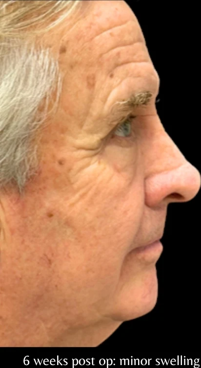 After: Blepharoplasty — profile · by Angelo Cuzalina, MD, DDS