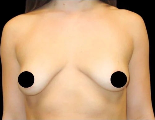 Before: Breast Augmentation · by Angelo Cuzalina, MD, DDS