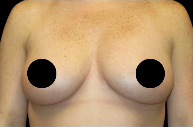 Before: Breast Augmentation · by Angelo Cuzalina, MD, DDS