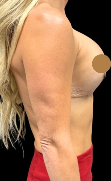 After: Breast Augmentation — oblique · by Angelo Cuzalina, MD, DDS