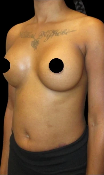 After: Breast Augmentation — oblique · by Angelo Cuzalina, MD, DDS
