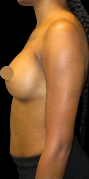 After: Breast Augmentation — profile · by Angelo Cuzalina, MD, DDS