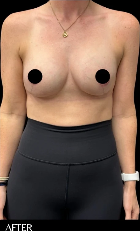 After: Breast Augmentation · by Angelo Cuzalina, MD, DDS