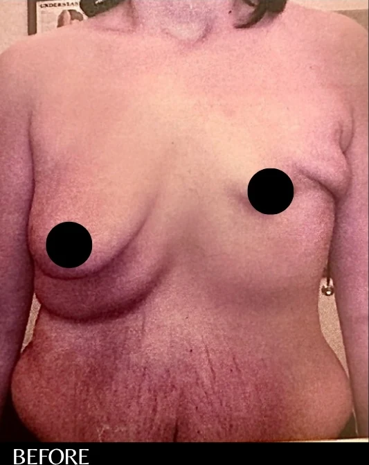 Before: Breast Reconstruction Aug/Lift · by Angelo Cuzalina, MD, DDS