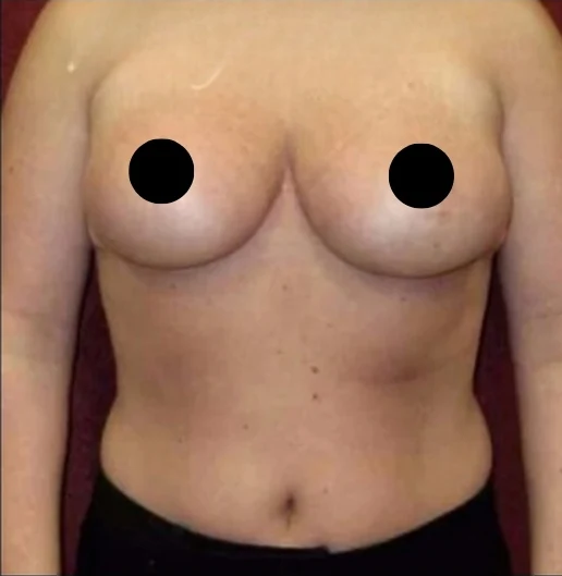 After: Breast Reduction & Lift · by Angelo Cuzalina, MD, DDS