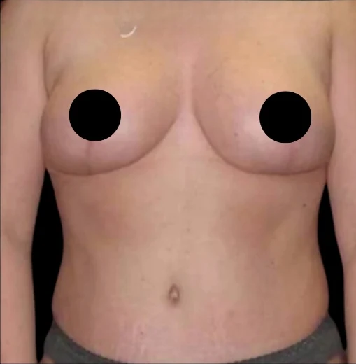 After: Breast Reduction & Lift · by Angelo Cuzalina, MD, DDS