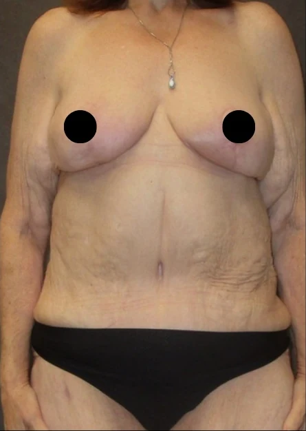 After: Full Tummy Tuck, Liposuction, Breast Reduction & Lift · by Angelo Cuzalina, MD, DDS