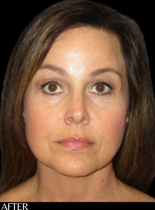 After: Endoscopic Forehead & Brow Lift — front · by Angelo Cuzalina, MD, DDS