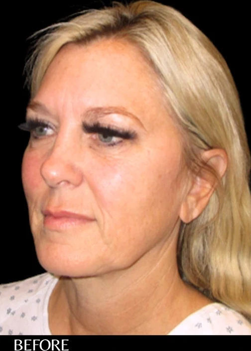 Before: Full Lower Face & Neck Lift, Endoscopic Forehead & Brow Lift, CO2 Laser Resurfacing — three-quarter · by Angelo Cuzalina, MD, DDS