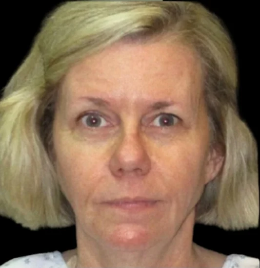 Before: Lower Face & Neck Lift, Fat Grafting, Laser Skin Resurfacing, Upper Blephs · by Angelo Cuzalina, MD, DDS