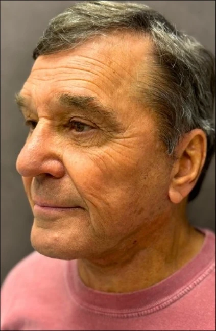 After: Lower Face & Neck Lift — three-quarter · by Angelo Cuzalina, MD, DDS