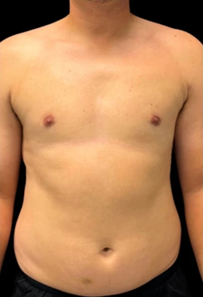 After: Lipo to Chest, Excision of Tissue with Vaser — front · by Angelo Cuzalina, MD, DDS