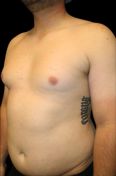 Before: Lipo to Chest, Excision of Tissue with Vaser — oblique · by Angelo Cuzalina, MD, DDS