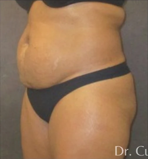 Before: Tummy Tuck & Lipo to Waist & Hips — oblique · by Angelo Cuzalina, MD, DDS
