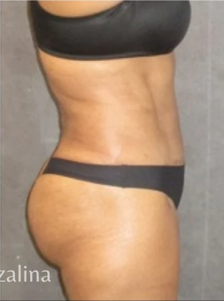 After: Tummy Tuck & Lipo to Waist & Hips — profile · by Angelo Cuzalina, MD, DDS