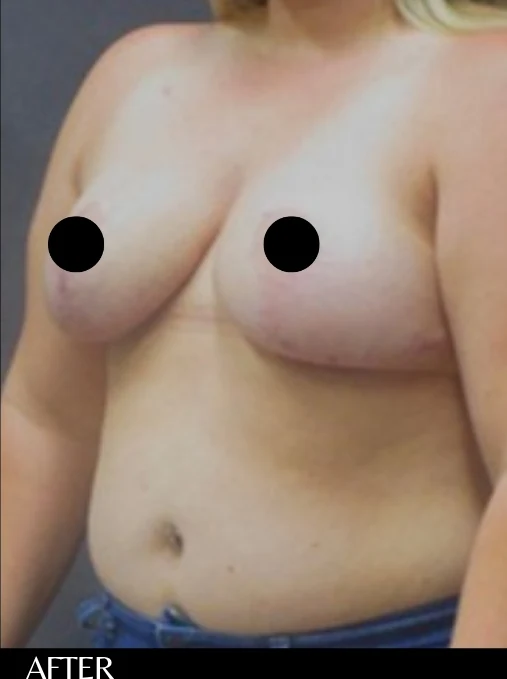 After: Breast & Lift · by Angelo Cuzalina, MD, DDS