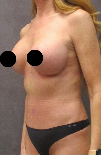After: Breast Aug/Lift, Tummy Tuck, Lipo360 · by Angelo Cuzalina, MD, DDS