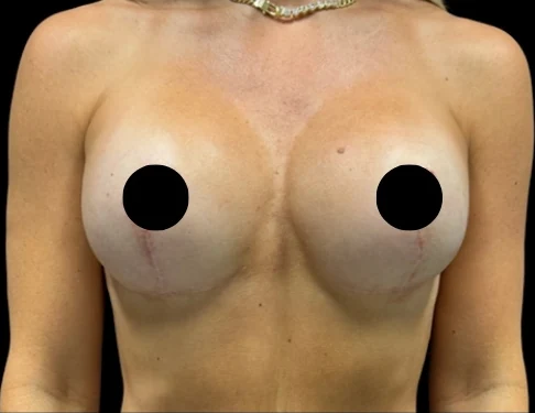 After: Breast Augmentation Lift · by Angelo Cuzalina, MD, DDS