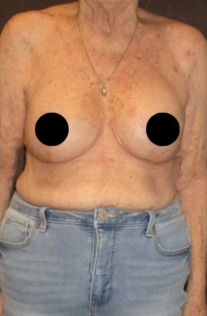 After: Breast Aug/Lift · by Angelo Cuzalina, MD, DDS