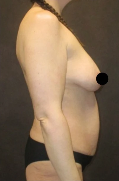 Before: Tummy Tuck, Lipo to Abdomen, Breast Aug/Lift & BBL — profile · by Angelo Cuzalina, MD, DDS