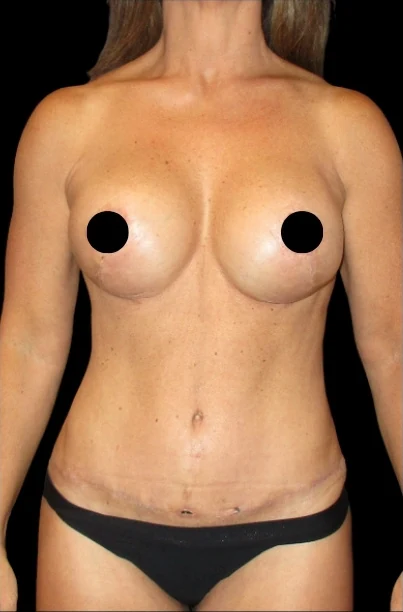 After: Breast Aug/Lift, Tummy Tuck, Lipo360 — front · by Angelo Cuzalina, MD, DDS