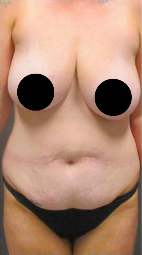 Before: Mommy Makeover · by Angelo Cuzalina, MD, DDS