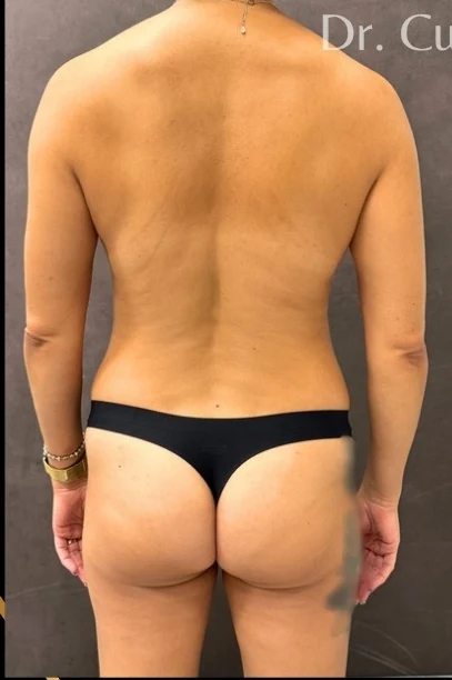 Before: Full Mommy Makeover (Breast Aug/Lift | Lipo 360 | Lipo to Hips & Thighs | Tummy Tuck | ... — back · by Angelo Cuzalina, MD, DDS