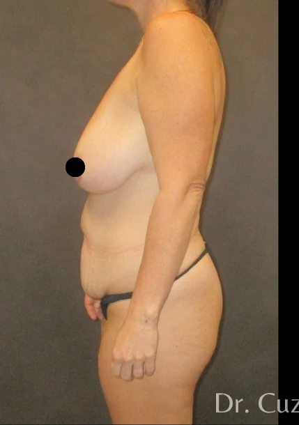 Before: Mommy Makeover — profile · by Angelo Cuzalina, MD, DDS
