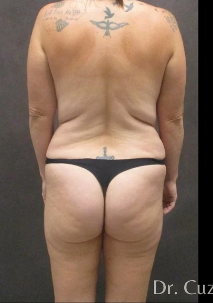 Before: Mommy Makeover · by Angelo Cuzalina, MD, DDS