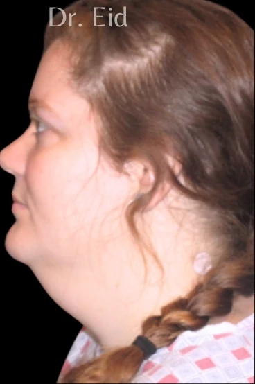 Before: Submentoplasty — profile · by Rola Eid, DO, FACOS, FACS