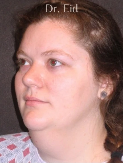 Before: Submentoplasty — three-quarter · by Rola Eid, DO, FACOS, FACS
