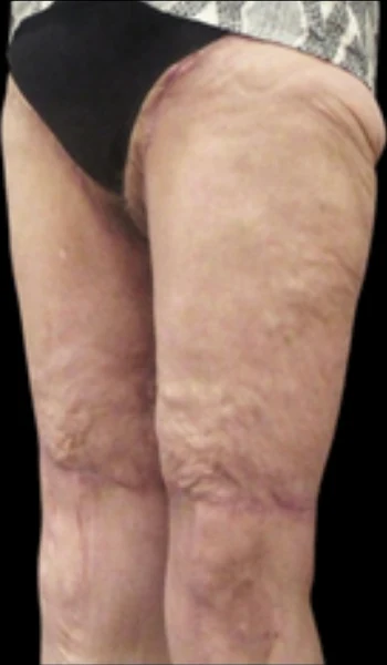After: Thigh & Knee Lift — profile · by Angelo Cuzalina, MD, DDS