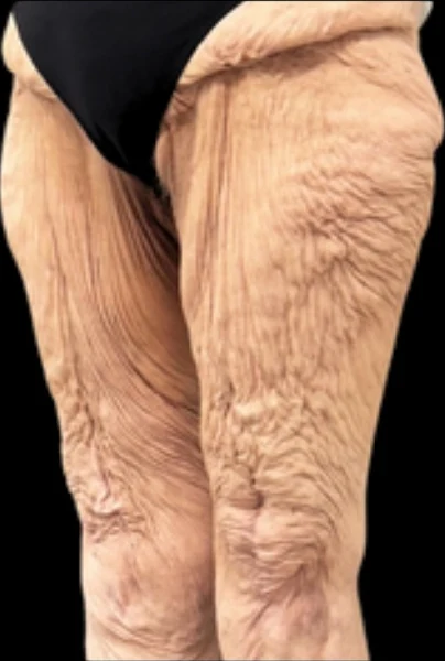 Before: Thigh & Knee Lift — profile · by Angelo Cuzalina, MD, DDS