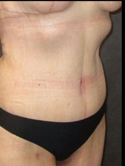After: Tummy Tuck / Excessive Skin Removal — three-quarter · by Angelo Cuzalina, MD, DDS