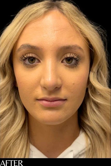 After: Rhinoplasty — front · by Angelo Cuzalina, MD, DDS