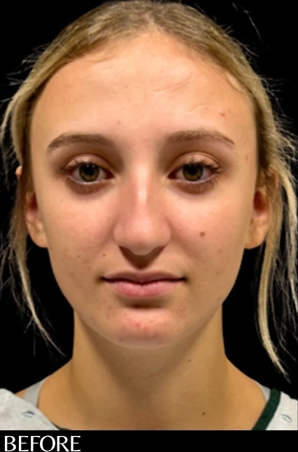 Before: Rhinoplasty — front · by Angelo Cuzalina, MD, DDS
