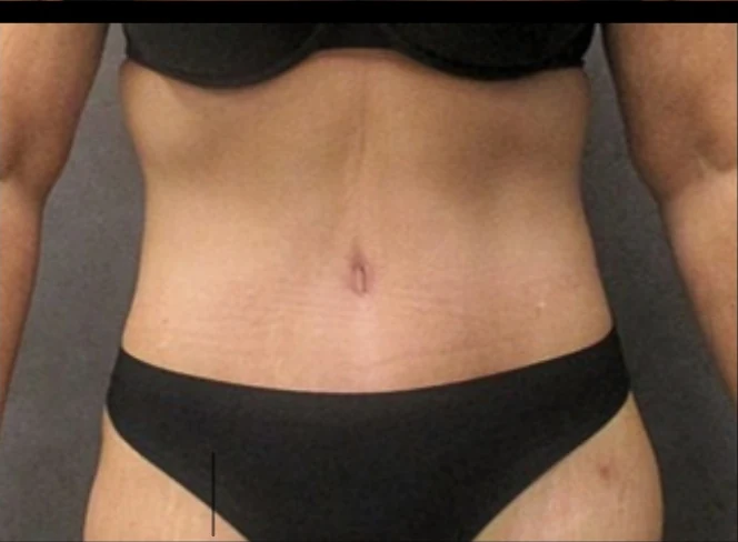After: Lipo360 & Tummy Tuck · by Angelo Cuzalina, MD, DDS