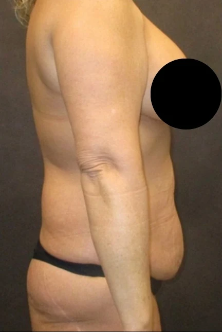 Before: Tummy Tuck & Lipo 360 to Waist and Hips — profile · by Angelo Cuzalina, MD, DDS
