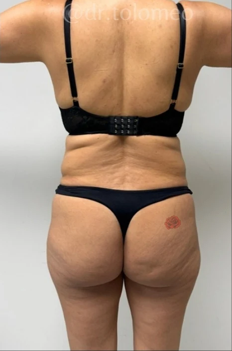 Before: Full Tummy Tuck, Hidef Lipo & BBL — back · by Pasquale Tolomeo, MD