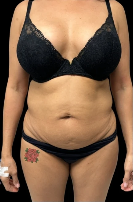 Before: Full Tummy Tuck, Hidef Lipo & BBL — front · by Pasquale Tolomeo, MD