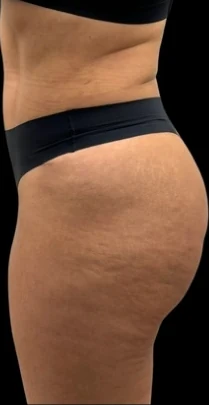After: Full Tummy Tuck, Hidef Lipo & BBL — oblique-back · by Pasquale Tolomeo, MD