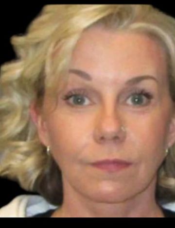 After: Deep plane facelift · by Dr. Cuzalina