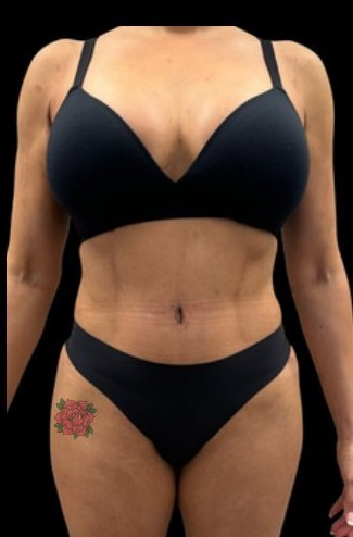 After: Tummy tuck, hi-def lipo & BBL — front · by Dr. Tolomeo