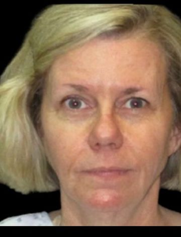 Before: Deep plane facelift · by Dr. Cuzalina