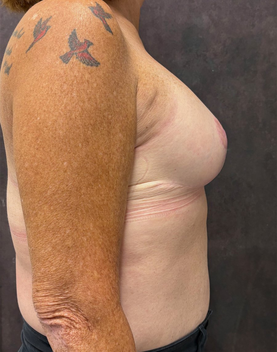 After: risk-reducing mastectomy with reconstruction — profile, 4 months · by Dr. Cuzalina