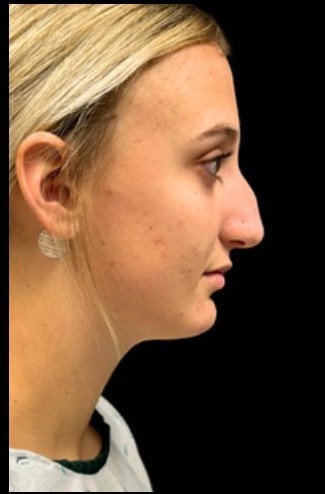 Before: Rhinoplasty — profile · by Dr. Cuzalina