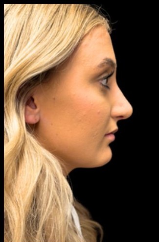 After: Rhinoplasty — profile · by Dr. Cuzalina